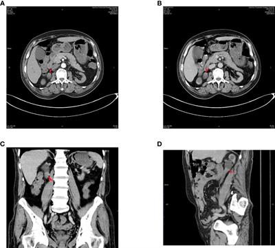 Chronic kidney disease with malignant peripheral nerve sheath tumor of the ureter: a case report